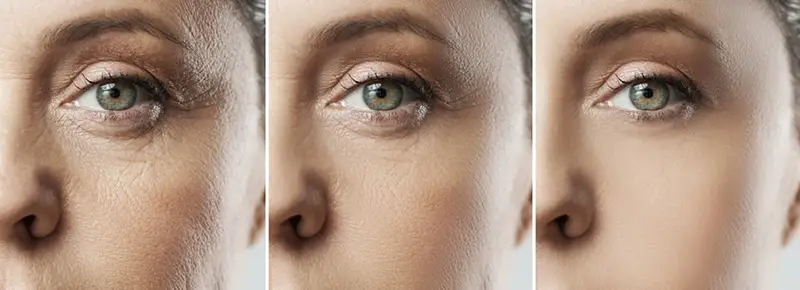 Ochi, înainte și după blefaroplastie